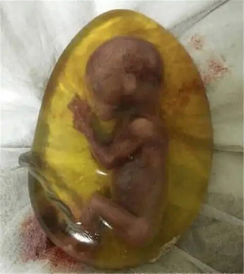 四,利用引产;一般在孕晚期,胎儿也已经成型,医生会注射药物,然后再让