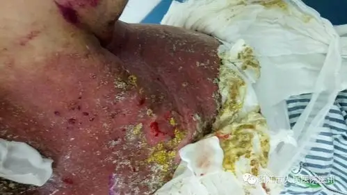 我院伤口造口门诊的护士敲黑板划重点啦!放射性皮炎得这样处理