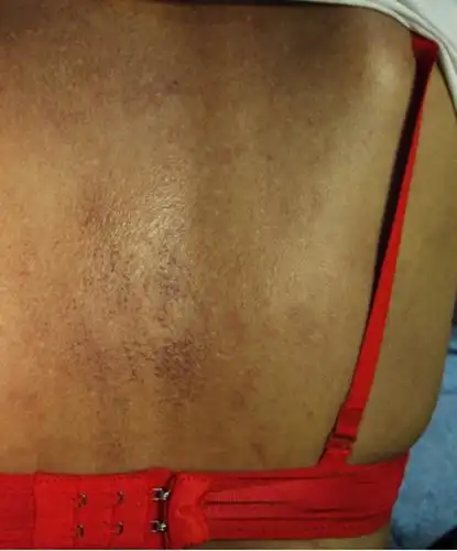 女性后背皮肤黑变病图片