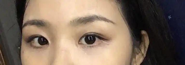 眼尾的沟怎么解决?