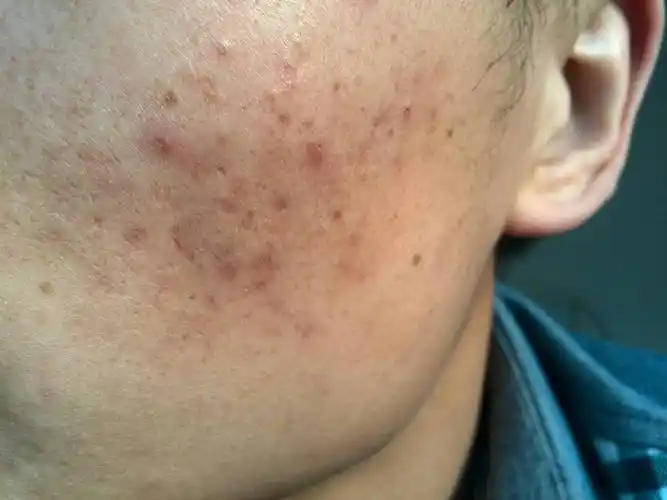本人男 21岁, 皮肤好差 以前长过痘痘 用手扣了现在留下好多痘印 , 还