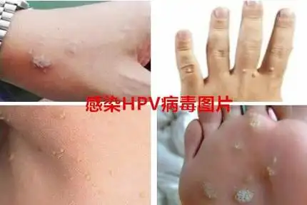 女性hpv初期症状图片大全