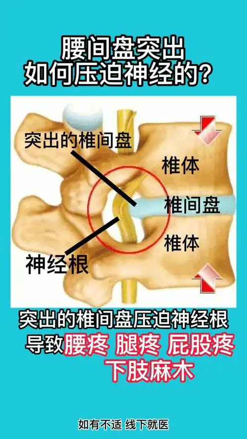 腰间盘突出如何压迫神经的