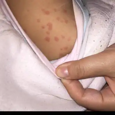 宝宝9个月,发高烧39度,身上起了这种红色的点点,是什麼,?该怎麼做?