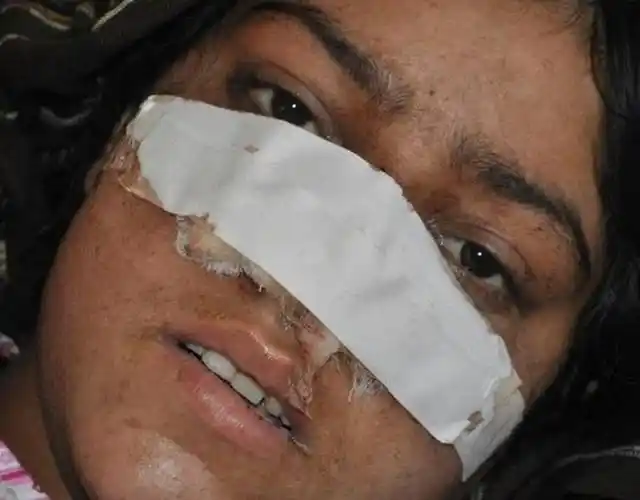 2016年1月19日报道,阿富汗发生骇人听闻的丈夫割掉妻子鼻子案.