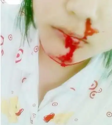 五官科2009-07-25 补充: 我是莫名其妙  不知道怎么了 鼻子就会流血