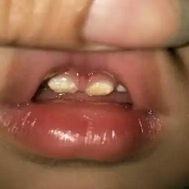 宝宝牙齿发黄_宝宝树