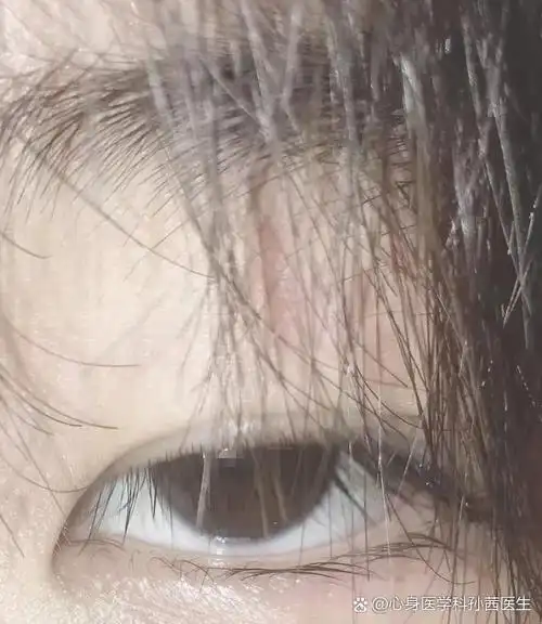 抑郁症患者的眼睛和正常人相比会有一些明显变化