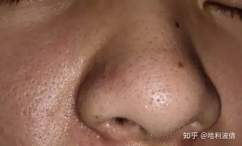 怎么样有效去黑头呢?