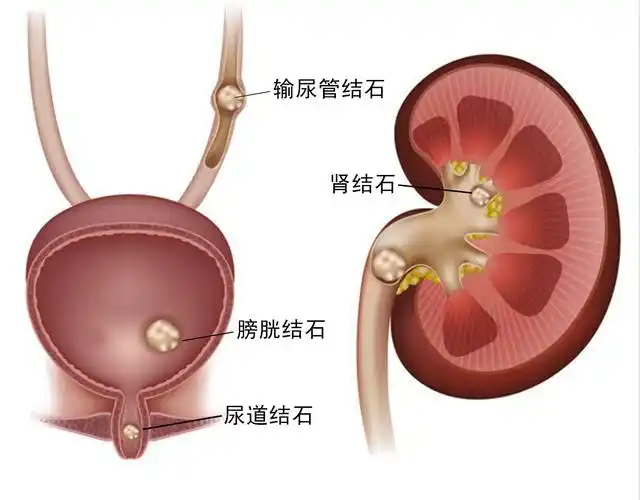 此外泌尿系统还有肾结石,膀胱结石,尿道结石,与输尿管结石共同构成