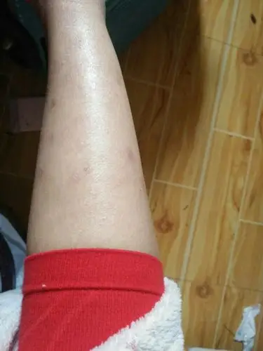 去年夏天蚊子咬的 留下的疤到现在都没消 要怎么办