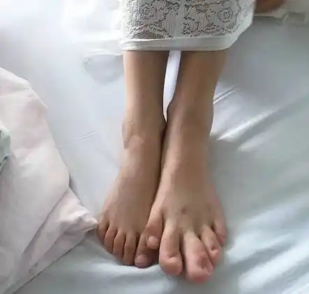 8岁女孩长了"巨型"脚趾一只脚要穿37码的成人鞋昨天,在姑姑王女士的