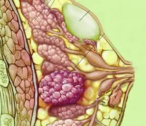 治疗乳腺囊肿的费用是多少