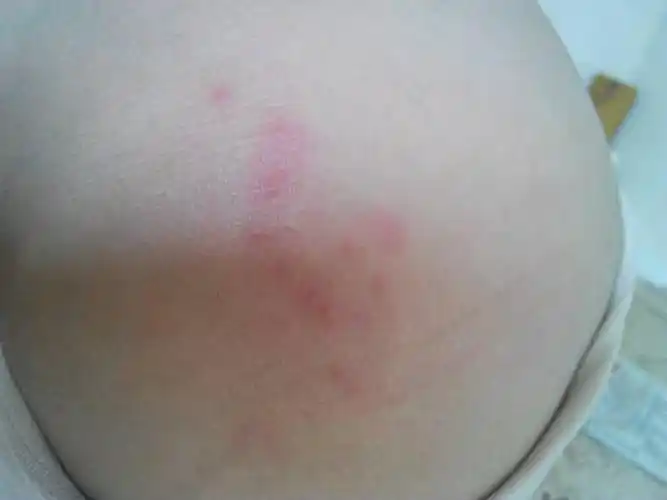 臀部长了一些很疼的粉色包,怎么回事啊?