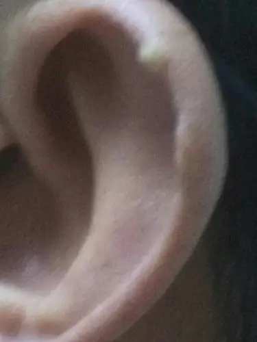 问一下耳朵长的白色的这个是什么东西,怎么引起的,怎么消除呢?