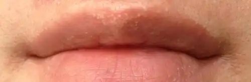 上嘴唇有白色颗粒,有医生说是异位性皮脂腺不需要治,我觉得很难看.