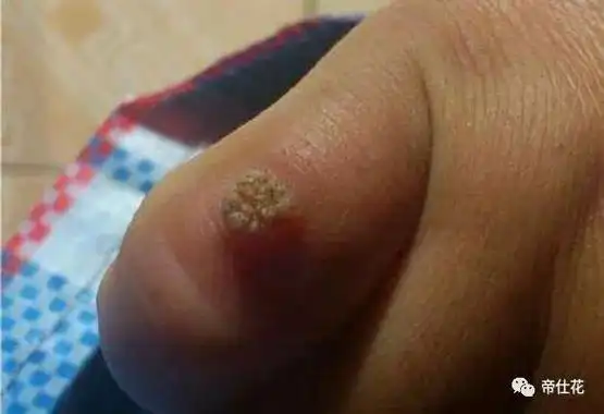 寻常疣试试这个方法,没有疼痛,安全祛除