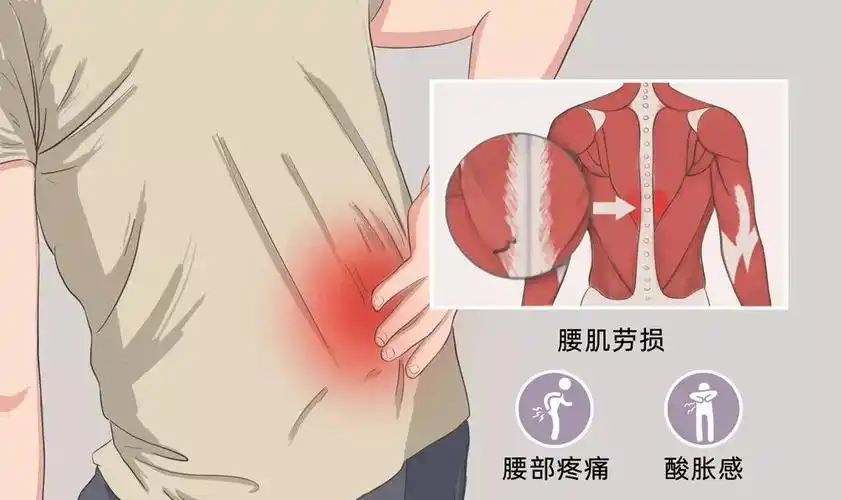 文仲骨科门诊常见疾病解析——腰肌劳损_腰部_工作_损伤