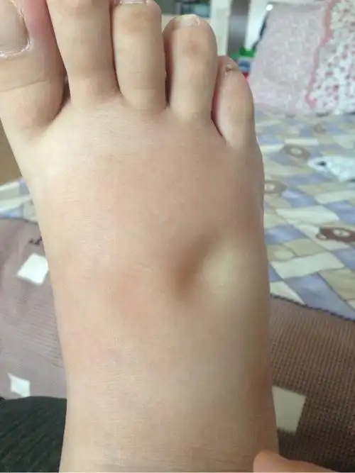 10个孕妈9个肿孕期水肿做好这几点让你告别大猪蹄子