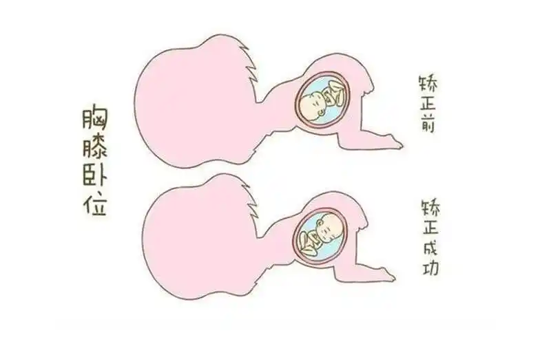 膝胸卧位纠正胎位图详解原理成功率时间尽数掌握