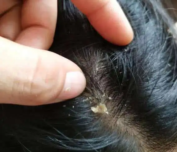 几种现象说明你洗发水在养头皮螨虫快看你有没有