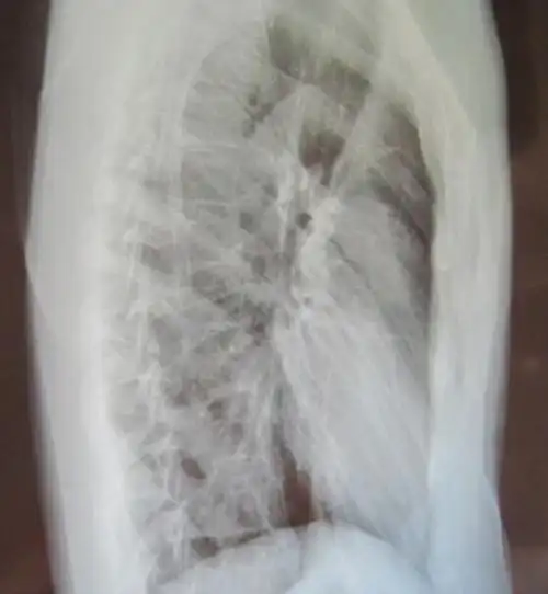 上医院检查一下,大夫说我有扁平胸,并且我拍了一张x光,发现我的椎骨到