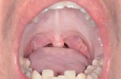 咀嚼槟榔相关口腔黏膜疾病的诊治吴颖芳博士