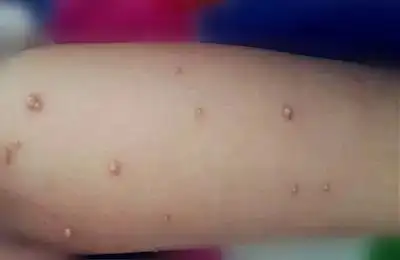 传染性软疣|瘊子|孩子_新浪育儿_新浪网