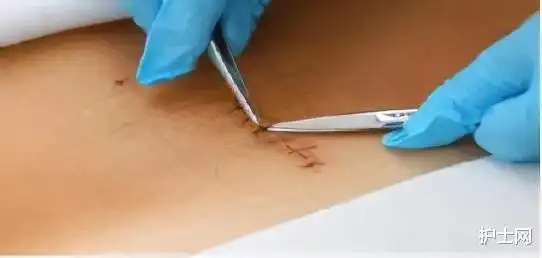 术后拆线那些事儿