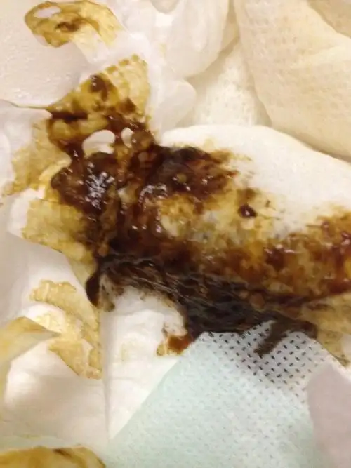 新生儿6天了 拉这种青褐色大便正常吗