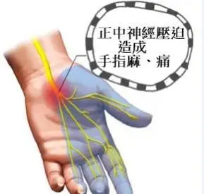 传岐弘医堂:手麻木是疾病的征兆,快来瞧一瞧!