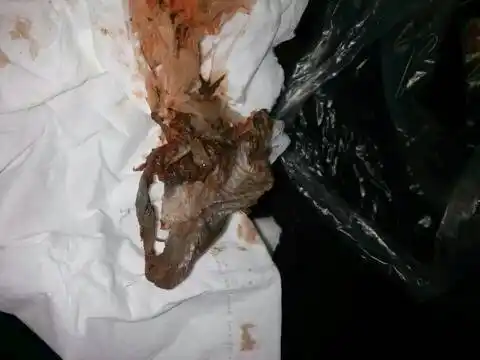 月经第一天阴道排出一坨皮一样的东西,到底是子宫蜕膜还是宫颈蜕膜?