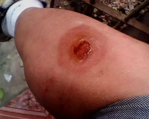 看过,说是伤口感染了~到现在为止伤口还未完全好~2个星期前又被烫伤了
