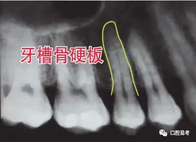 根尖周脓肿:根尖周肉芽肿:根尖周囊肿:根尖周致密性骨炎:牙周炎牙片