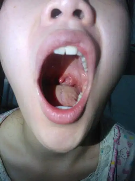 悬雍垂过长症的检查