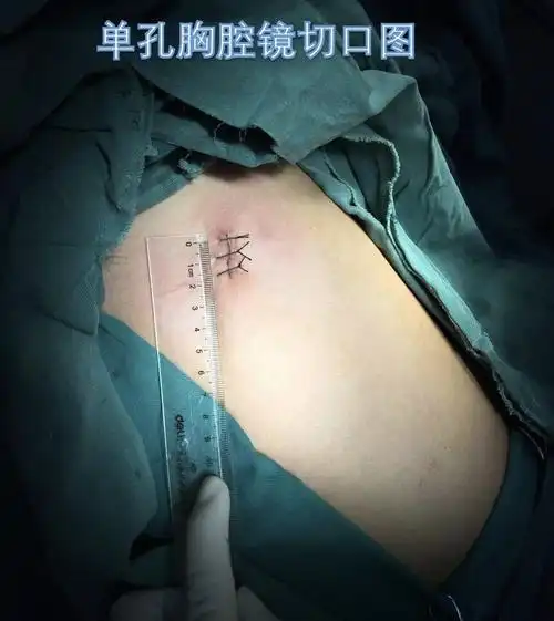 早期肺癌和肺结节胸腔镜肺段或亚段切除术;胸-腹腔镜联合食管癌和贲门