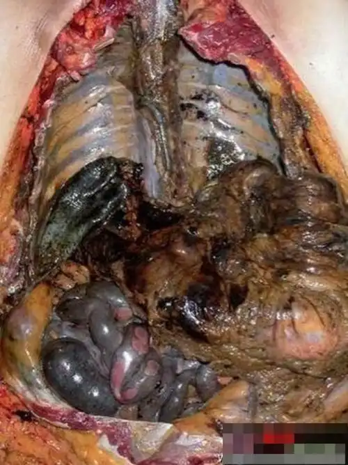 吸烟者的肺(图片)