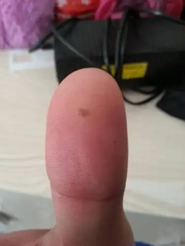 手拇指长了一个黑黑,不知道是什么,剪了又长出来,而且里面黑的东西