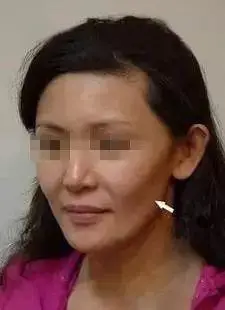 脸部有凹陷怎么办