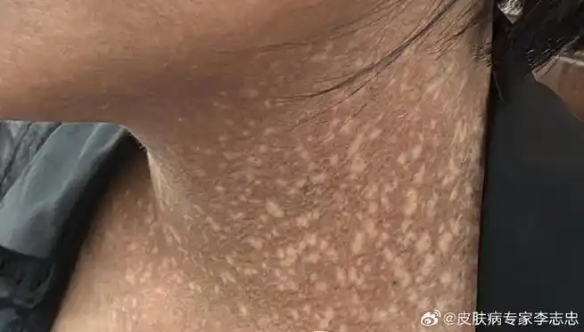 可以用中药内调配合外用软膏 西药 光电疗法治疗,可以让皮肤恢复正常.