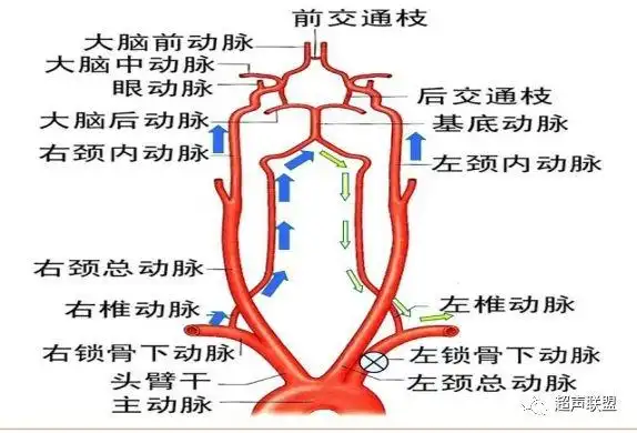 左侧锁骨下动脉狭窄