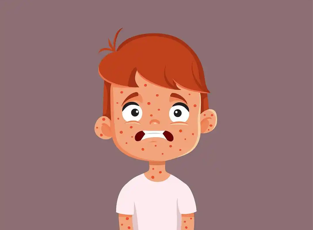 孕妇与麻疹:注意事项和预防措施 孕妇面临感染麻疹的风险时需要格外