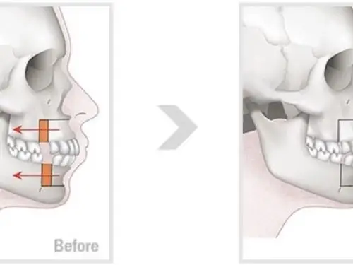 凸嘴牙性和骨性的区别