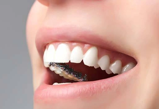 隐形牙套效果图片7
