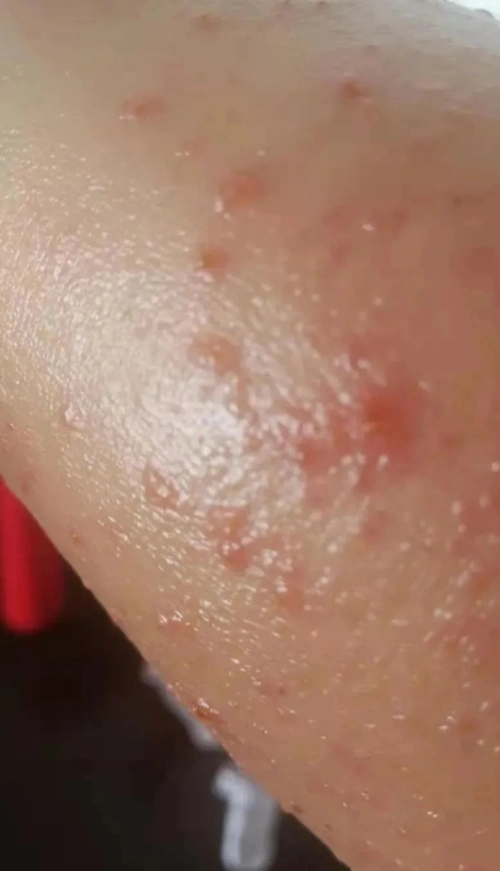 一个多年久治不愈的手脚干性湿疹