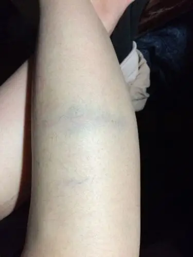 腿碰了一下,肿了有淤青,怎么消呢?