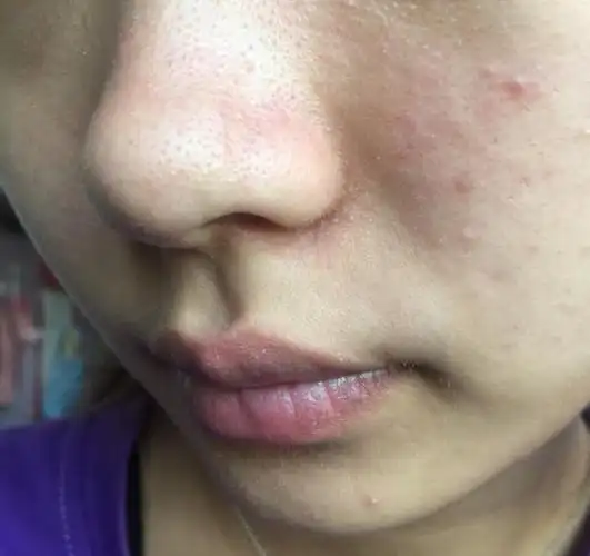 试试这样去黑头,不做草莓鼻女孩!