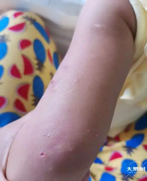 小孩身上有毒气长的毒痘痘有没有什么方法解决