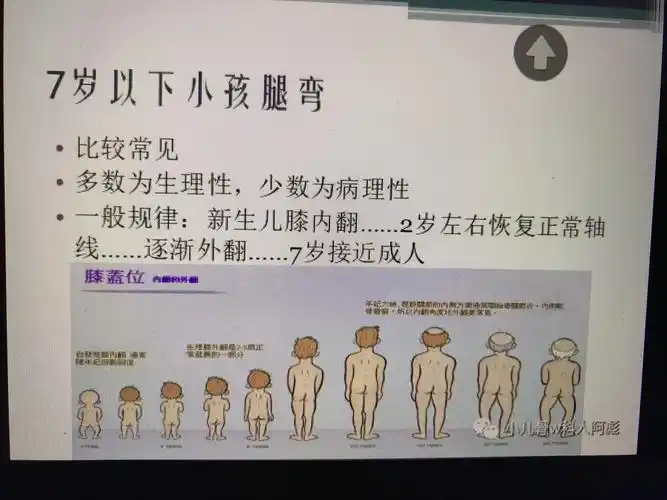 婴儿从出生到2岁一般都是"o"型腿,到2岁以后逐渐变成"x"型腿,直到