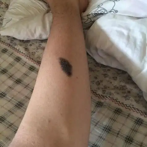 小腿有胎记算命 脚背上有胎记算命-神算网